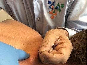 Dry needling door fysiotherapeut van MTC Zoetermeer