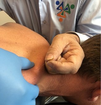 behandeling triggerpoint in de nek met dry needling
